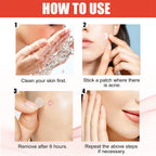 Hydrocolloid Acne Pimple Patches – Invisible Spot Care Set